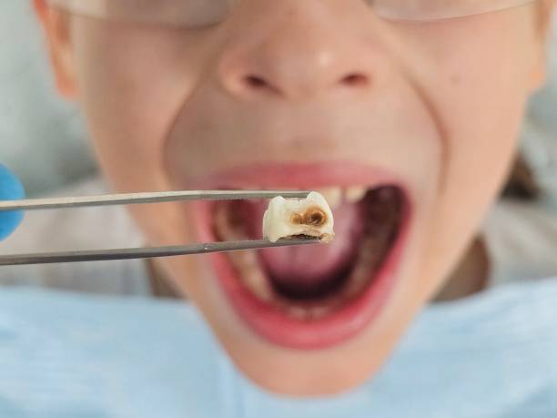 Best Emergency Dental Care for Broken or Chipped Teeth in Fairchance, PA